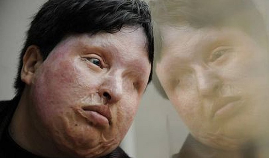 UPDATE: Acid Blinding Punishment Stopped in Tehran