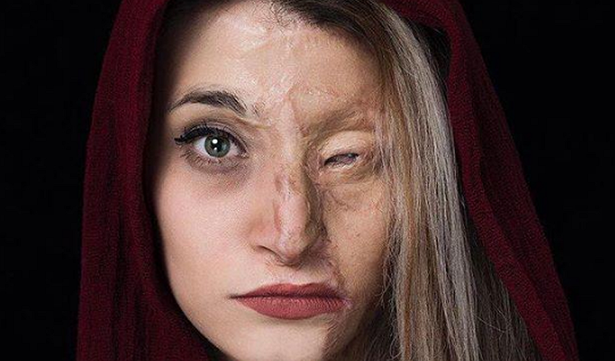 تقویت قوانین خشونت علیه زنان؛ پاشنه آشیل اسیدپاشان