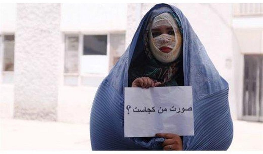 اسیدپاشی: قتل بدون مردن