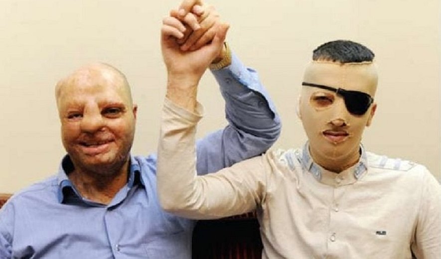 بیشترین قربانیان اسیدپاشی را مردان تشکیل می‌دهند یا زنان؟